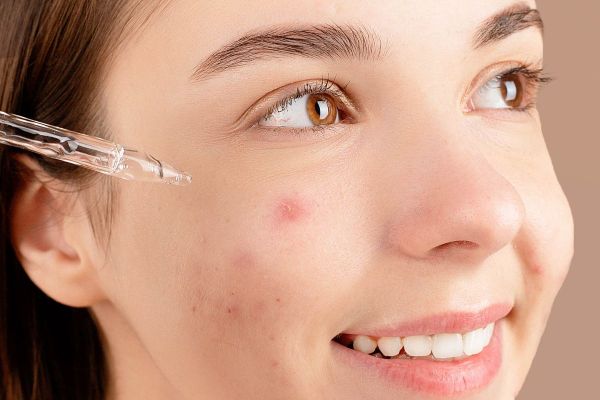 Da dầu mụn mùa hè: kiểm soát nhờn mà không khiến da "khát nước"