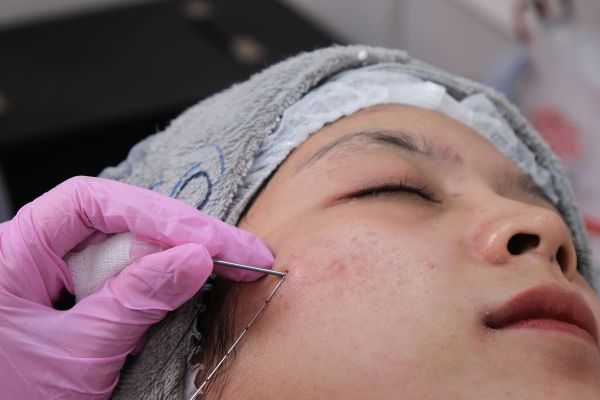 Vi kim tế bào gốc: cơ chế, lợi ích và những lưu ý quan trọng