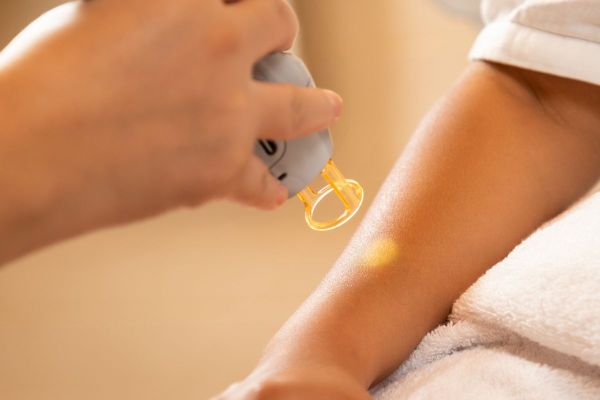 Triệt lông bằng laser: giải đáp 8 câu hỏi thường gặp nhất