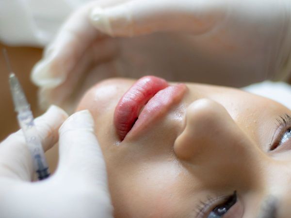 Tiêm filler môi căng mọng