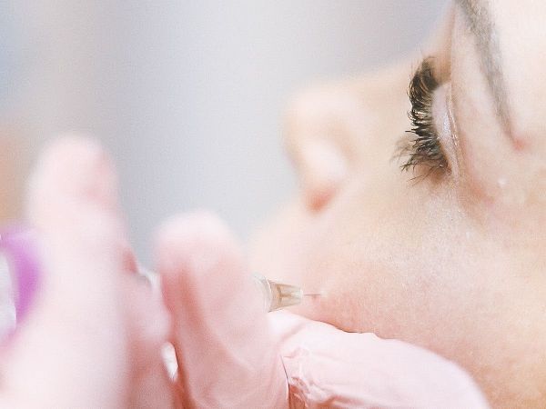 Tiêm filler rãnh cười & thái dương