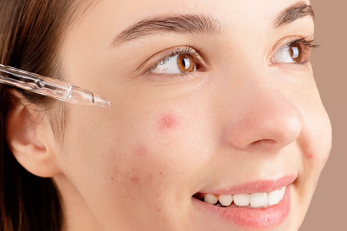 Da dầu mụn mùa hè: kiểm soát nhờn mà không khiến da "khát nước"
