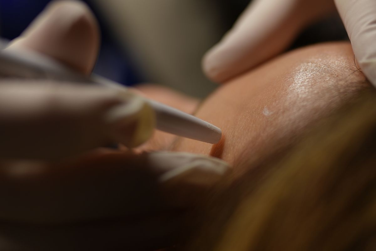 Căng chỉ collagen có an toàn không? Những điều cần biết trước khi làm